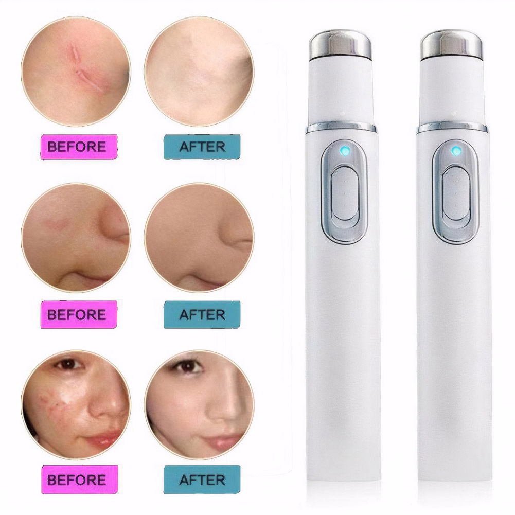 Blue Light Therapy Acne Pen He - Acne Light Therapy Pen ulasan dan harga